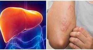 2 bộ phận đột nhiên bị ngứa đừng lầm tưởng là dị ứng, có thể là dấu hiệu của K gan, chớ chủ quan